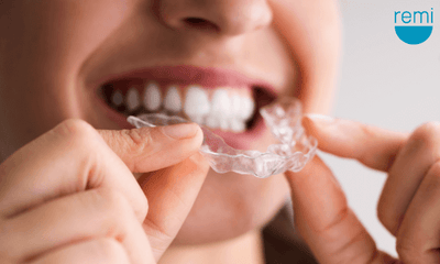 Keep Your Teeth Grinding Mouth Guard Fresh with Easy Cleaning Methods