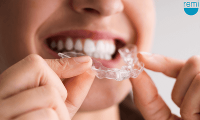 What to Expect When Wearing Your Mouth Guard the First Night