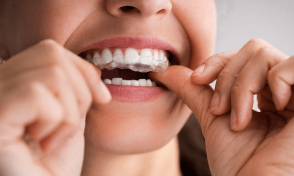 “Why Is My Mouth Guard Turning Yellow?” Here’s What To Do! - Remi