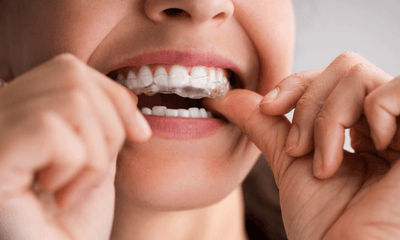 “Why Is My Mouth Guard Turning Yellow?” Here’s What To Do!