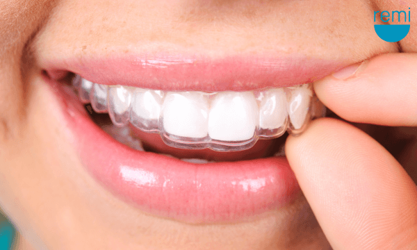 The Benefits of Wearing a Night Guard for Bruxism