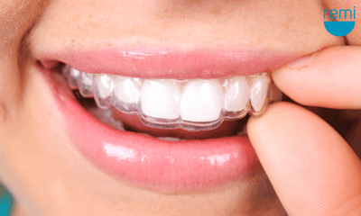 The Benefits of Wearing a Mouth Guard for Bruxism