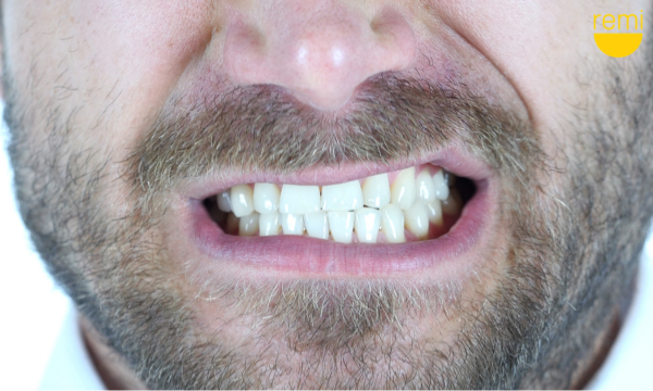 Beyond the Bite: Exploring Hunger-Induced Habits and Their Role in Teeth Grinding | Remi