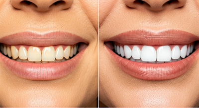 From Dull to Dazzling: The DIY Guide to Teeth Whitening with Remi