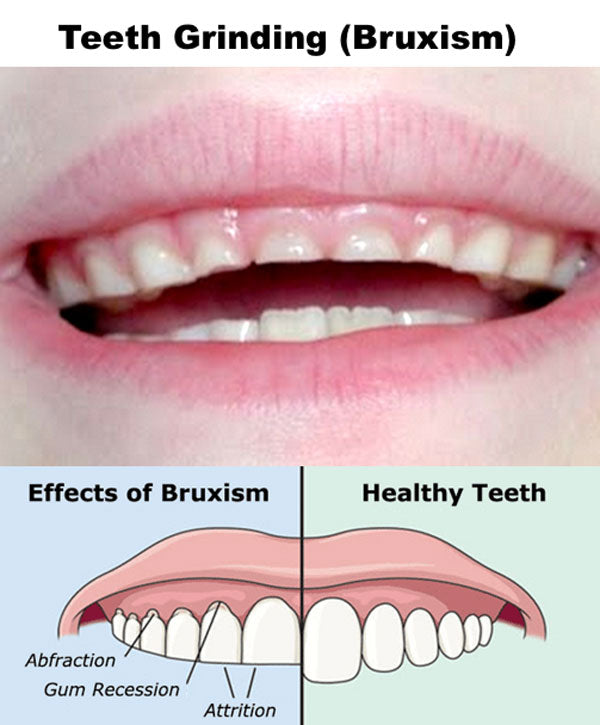 Teeth Clenching During Exercise: Causes and Solutions