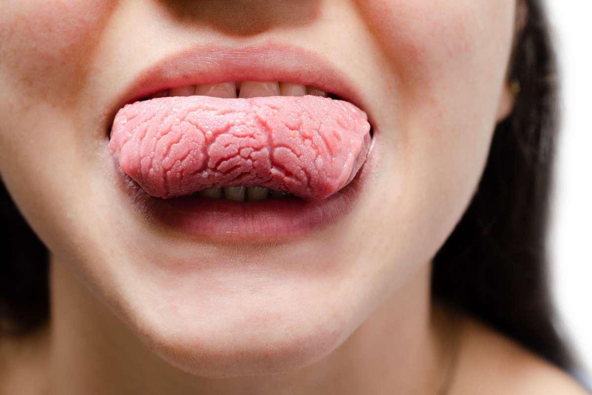 Indentations in Tongue