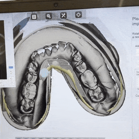 Digital dental scan displayed on a computer screen.