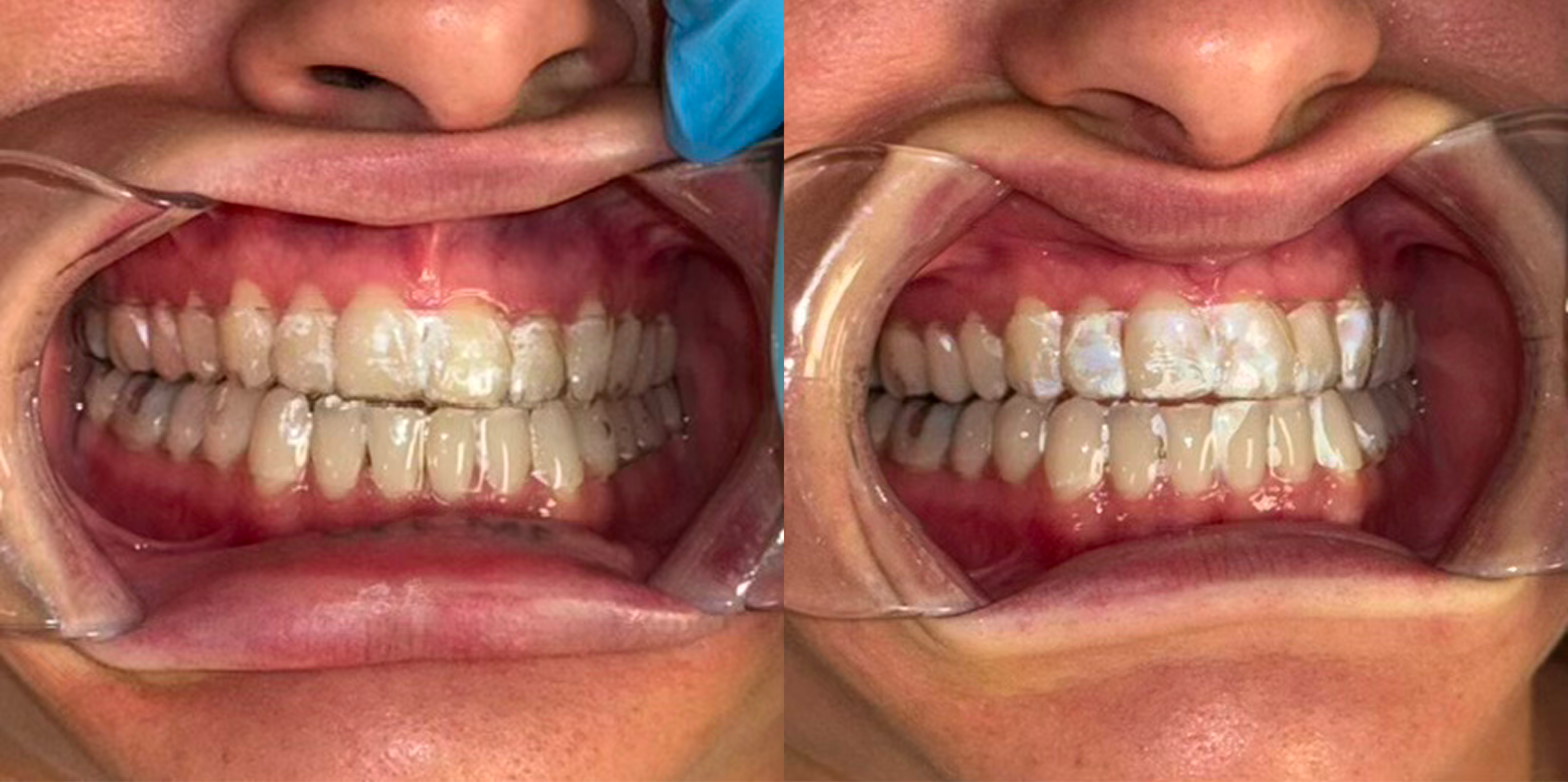 Close-up images of a person's mouth wearing clear aligners, with cheeks held back by retractors; the left side shows a gloved hand, while the right side does not.