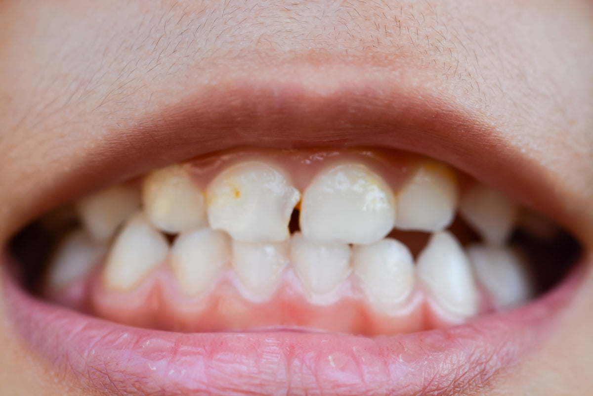 Teeth Sensitivity