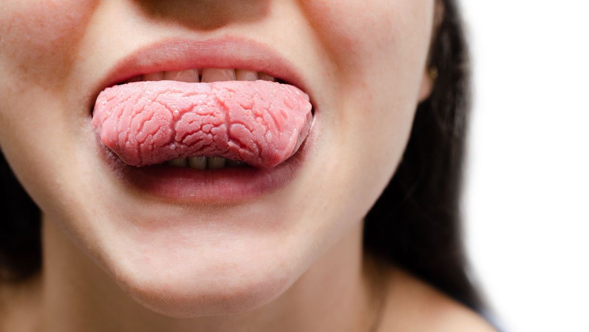 Indentations in Tongue